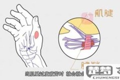 大拇指腱鞘炎怎么治疗?最佳治疗方法及自我缓解技巧