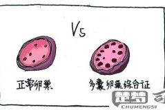 多囊卵巢综合症怎么办？综合治疗与自然疗法全解析