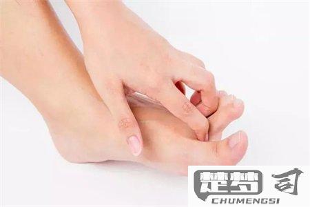 怎么判断是不是脚气？脚气的早期症状与预防方法全解析