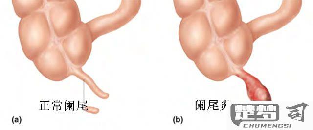 阑尾炎怎么缓解疼痛？科学应对方案与自然方法