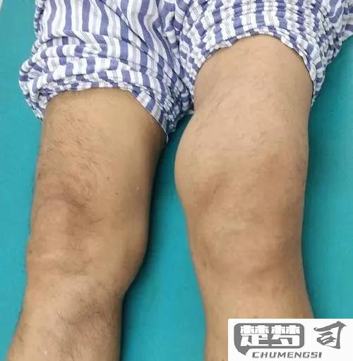 膝盖有积液怎么治疗？最佳治疗方法与预防措施全解析