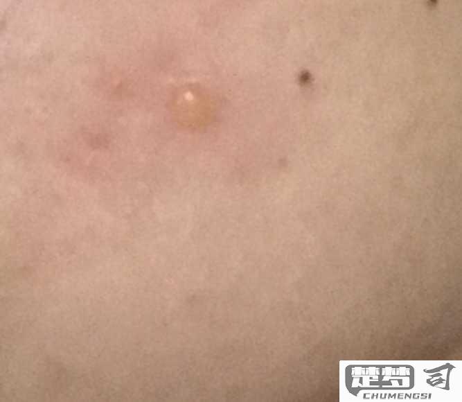 脸上长水泡怎么回事？原因、快速消除方法及就医指南