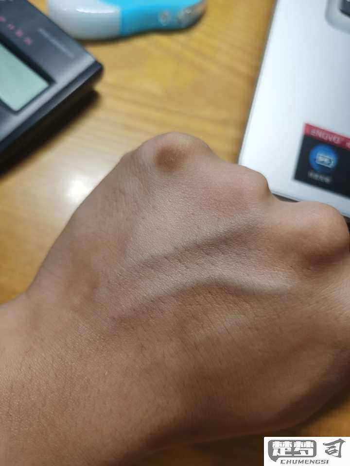 手背发黑是怎么回事？可能的原因及改善方法