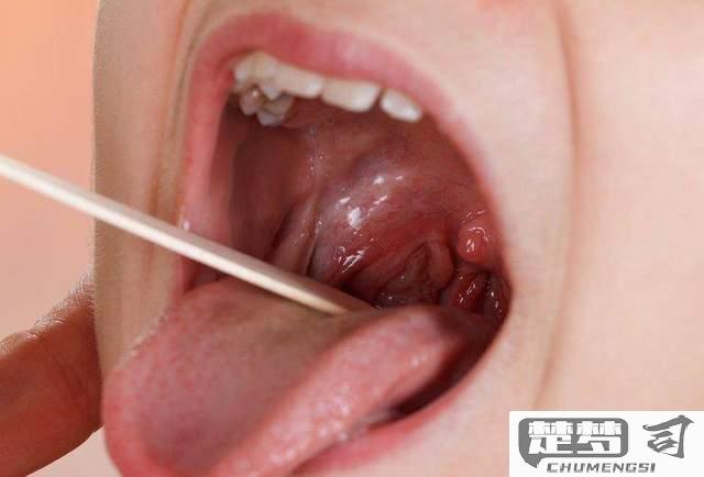 扁桃体结石怎么治疗最有效？家庭护理与医疗干预全解析