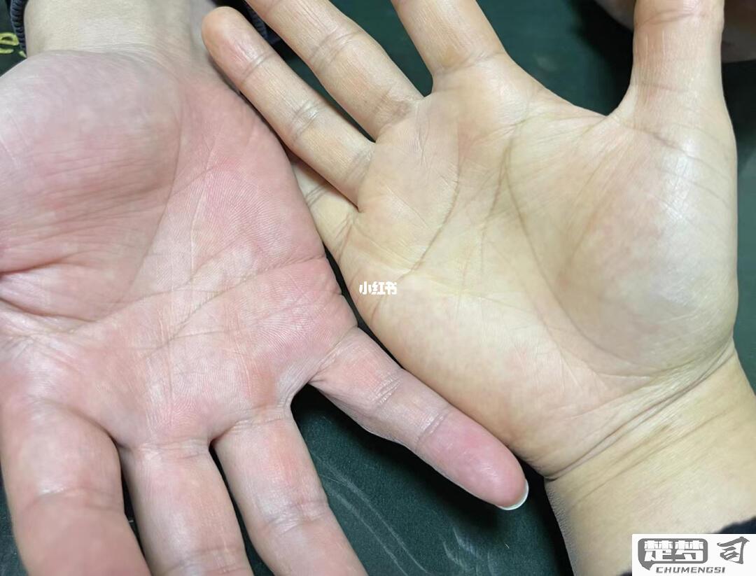 手心发黄是怎么回事？可能的原因及自然疗法改善方法