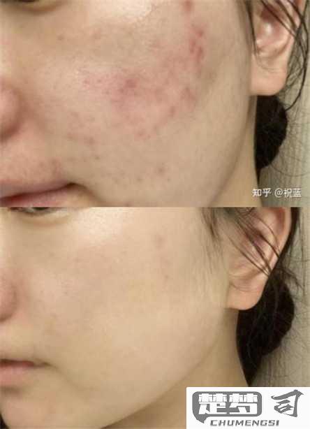 脸上红色痘印怎么消？有效方法与产品推荐