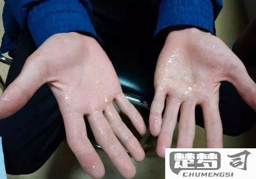 手容易出汗怎么解决？日常护理与医疗干预全指南