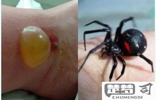 被蜘蛛咬了会怎么样？识别症状与急救措施全指南