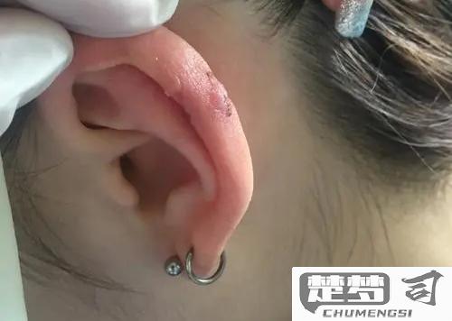 打完耳洞后怎么护理才能避免感染？