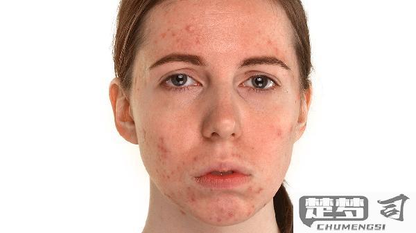 脸上红痘印怎么消除？日常护理与专业治疗方案全解析