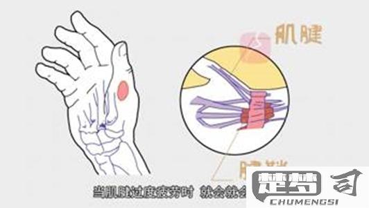 大拇指腱鞘炎怎么治疗？最佳治疗方法及自我缓解技巧