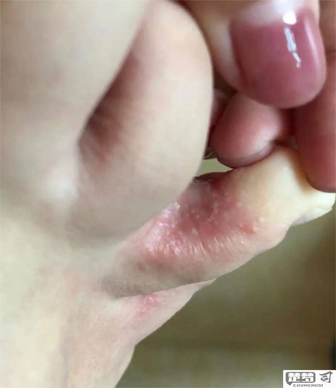脚趾缝烂脱皮痒怎么办？有效的治疗与预防方法