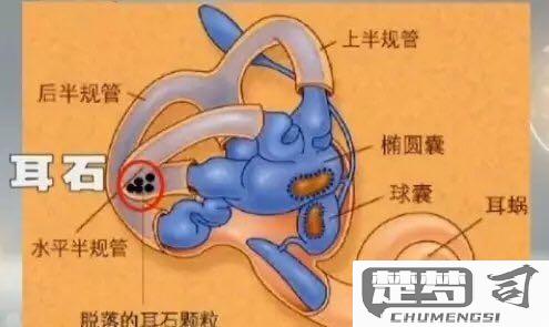 怎么判断是不是耳石症？耳石症的症状与专业检查方法详解