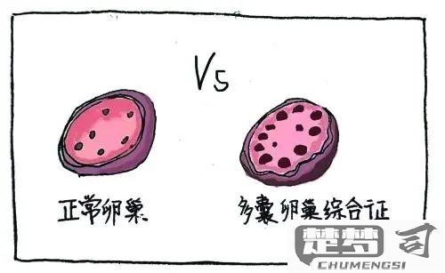 多囊卵巢综合症怎么办？综合治疗与自然疗法全解析