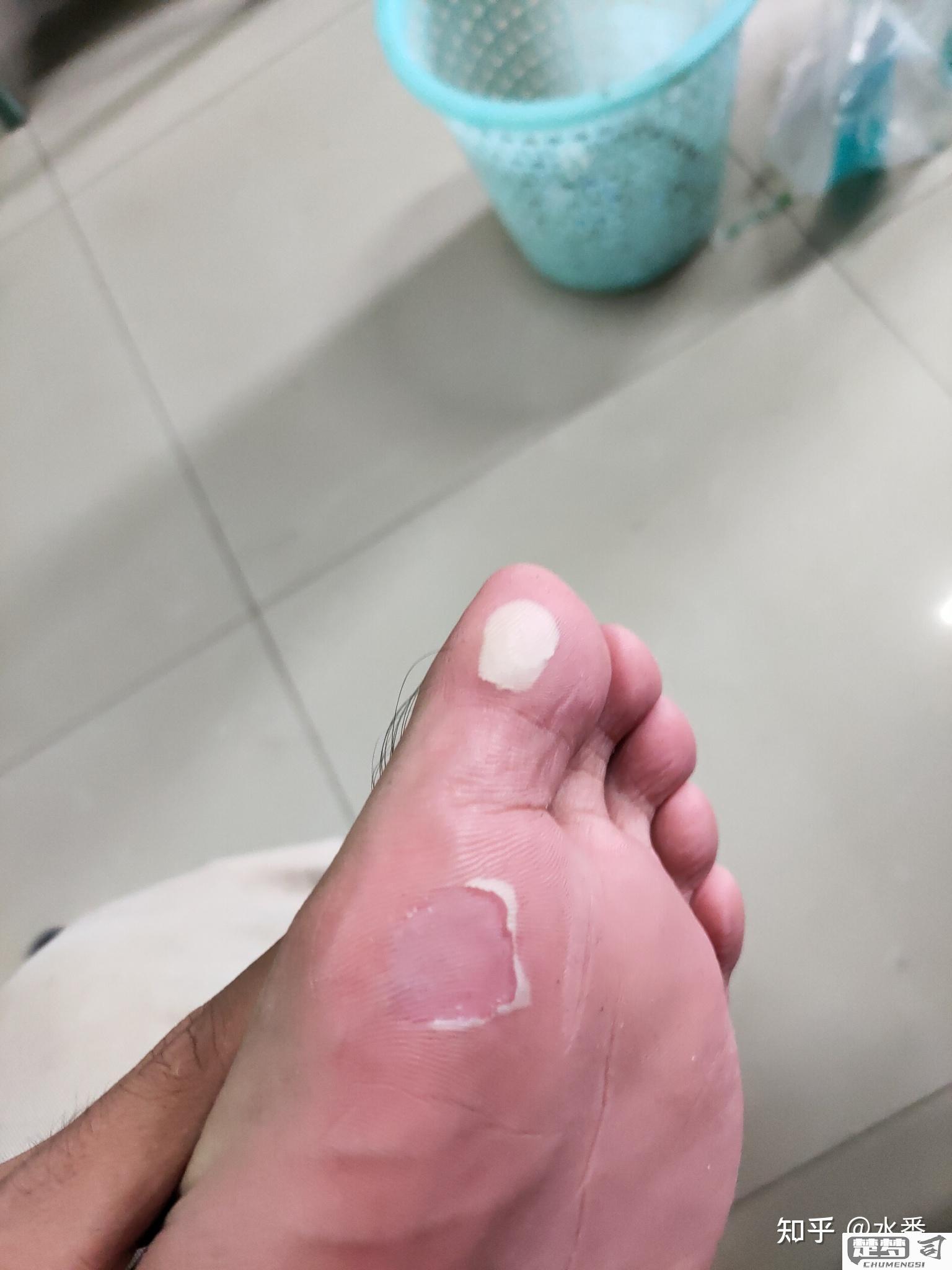 脚上磨出了水泡怎么办？快速处理与预防方法全解析