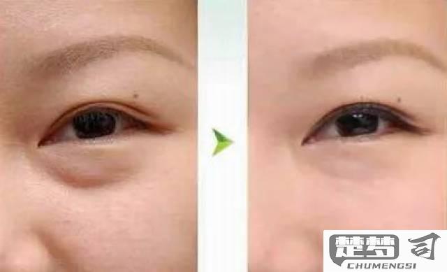 怎么去眼袋最快最有效？医美与家庭护理全攻略