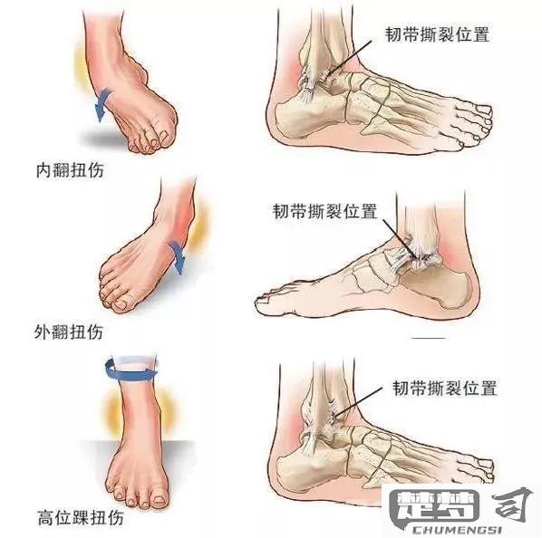 脚踝扭伤怎么快速恢复？专家推荐的恢复方案与运动指南