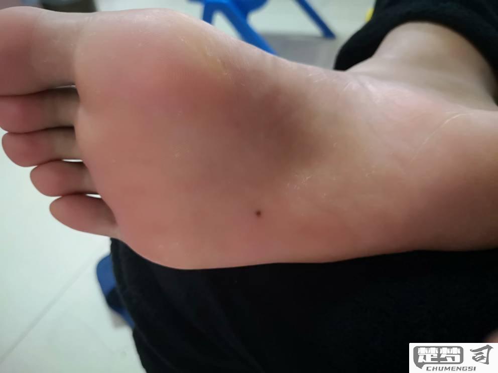 脚底长黑痣是怎么回事？需要担心吗？