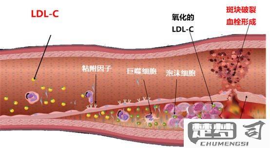 动脉硬化斑块怎么清除？医学治疗与自然方法全解析