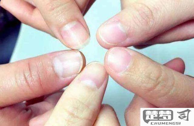 指甲竖条纹是怎么回事？可能的原因及预防方法