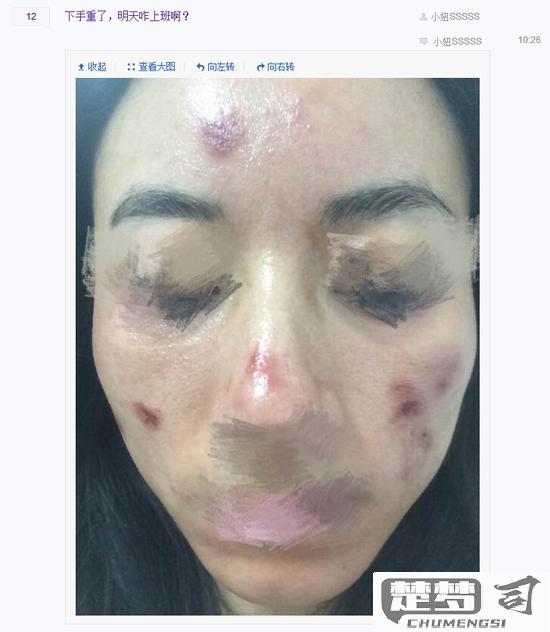 脸上淤青怎么快速消除？有效方法与护理指南