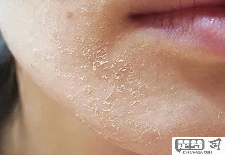 皮肤干燥起皮痒怎么办？有效的解决方案和日常护理方法