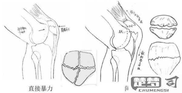髌骨骨折怎么康复训练？分阶段详细指南